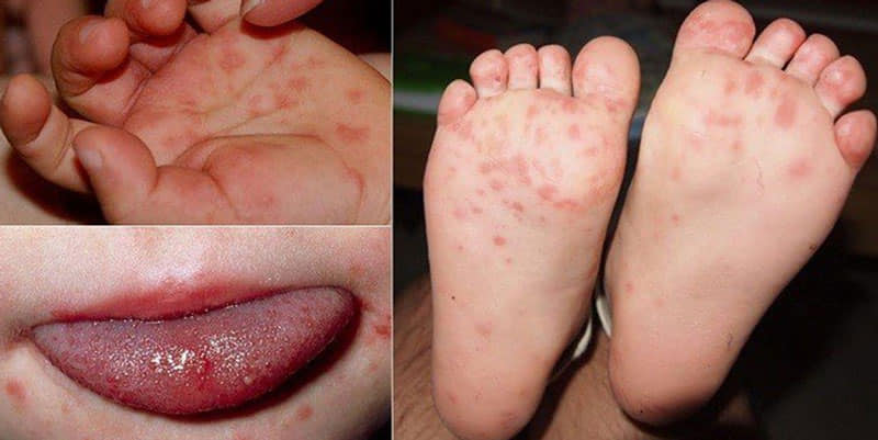 10 ĐIỀU CẦN BIẾT ĐỂ PHÒNG TRÁNH KHI BỆNH TAY CHÂN MIỆNG ĐANG VÀO MÙA !