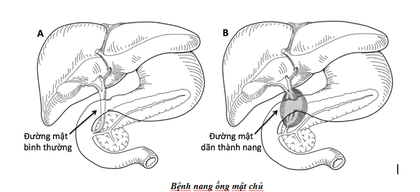 NHỮNG ĐIỀU CẦN BIÊT VỀ BỆNH NANG ỐNG MẬT CHỦ Ở TRẺ EM